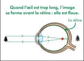 Schéma montrant le défaut de vision du myope