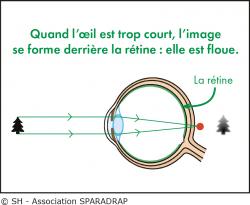 Schéma illustrant le problème de vision de l'hypermétrope