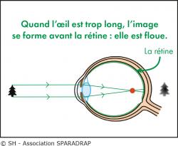 Schéma montrant le défaut de vision du myope